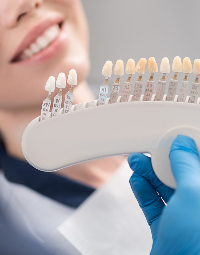 Dentist holding a shade guide for veneers in front of a patients smile