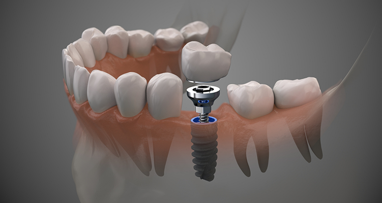 Illustration of a dental implant in Wilmington replacing a missing lower tooth