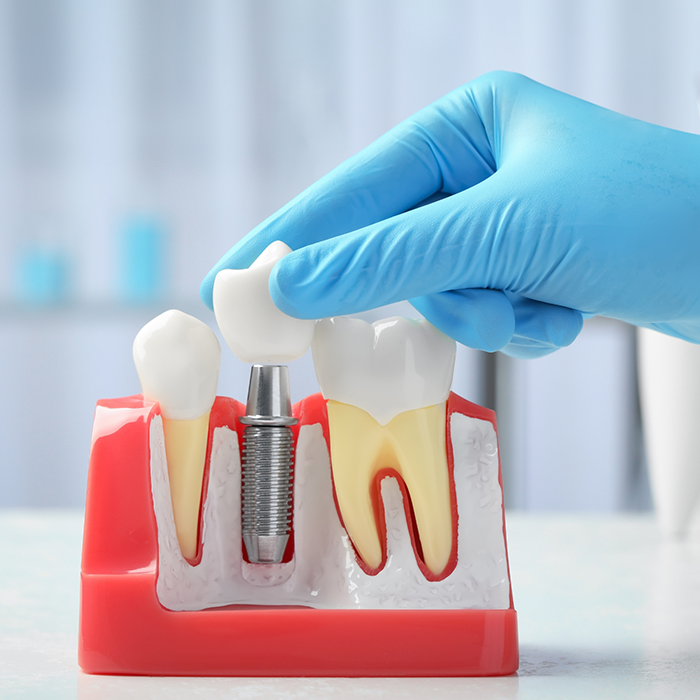 Dentist placing a crown on a model of a dental implant