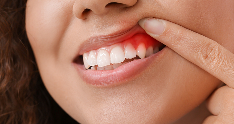 Woman pointing to her red gums before gum disease treatment in Wilmington