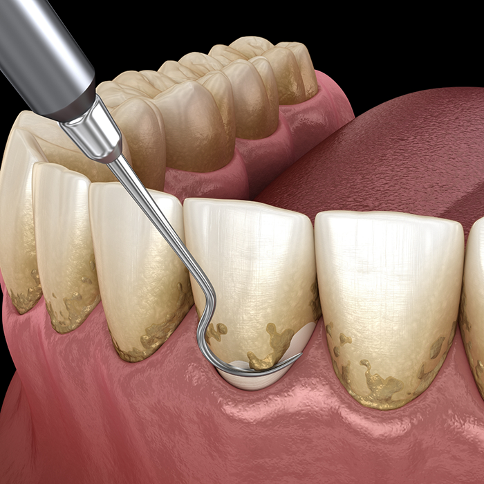 Illustrated dental scaler clearing tartar buildup along the gumline