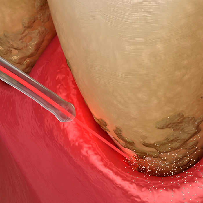 Illustrated dental laser treating gum disease