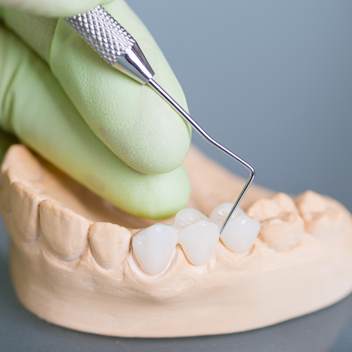 Dentist adjusting a model of the teeth with a dental bridge replacing three teeth