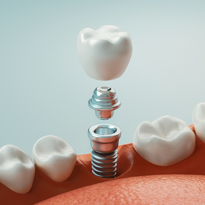 Illustration of a dental implant and crown replacing a missing lower tooth