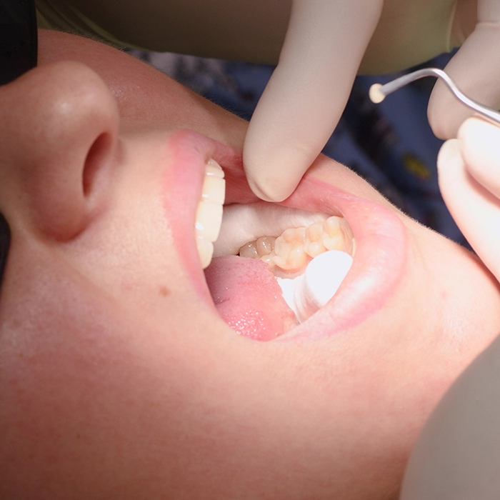 Dentist placing a tooth colored filling in a patients tooth