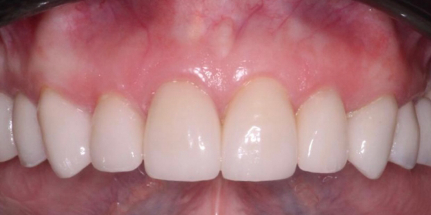 Upper arch of white evenly aligned teeth