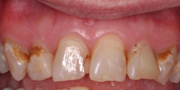 Upper arch of teeth with multiple stains and crooked teeth