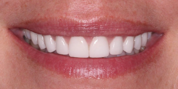 Smile after whitening slightly yellowed teeth