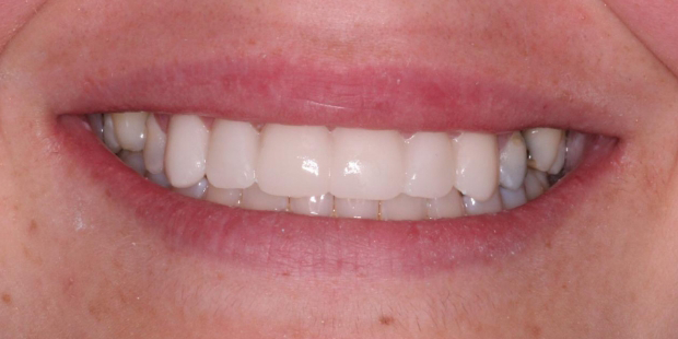 Smile after closing small gaps between the teeth