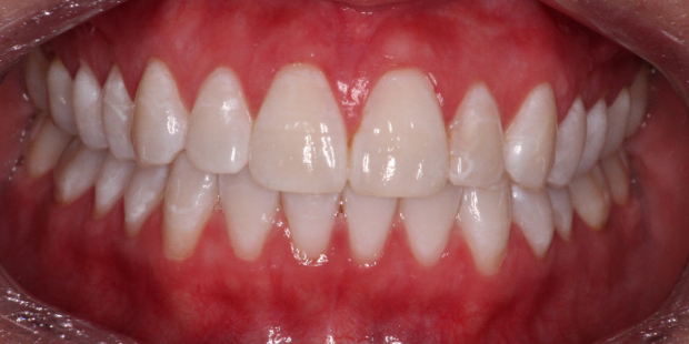 Mouth with whiter teeth