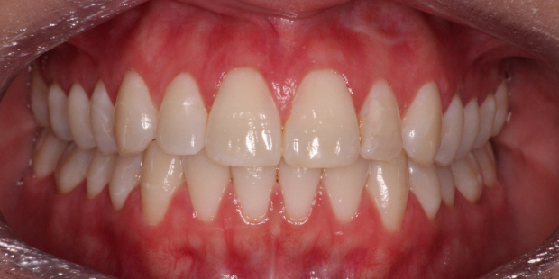 Mouth with straight but slightly yellowed teeth