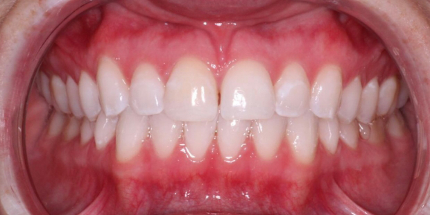 Mouth after correcting minor tooth discoloration