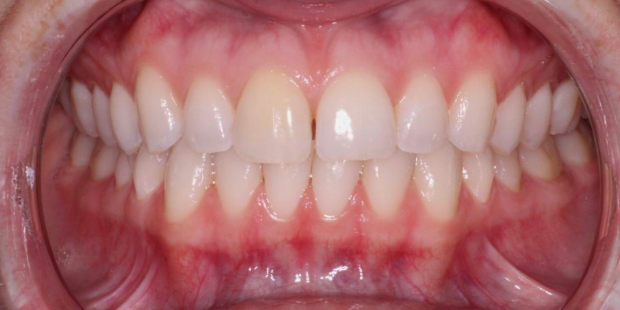 Mouth with minor yellow tooth discoloration