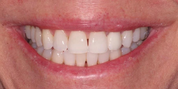 Smile after straightening slightly misaligned teeth