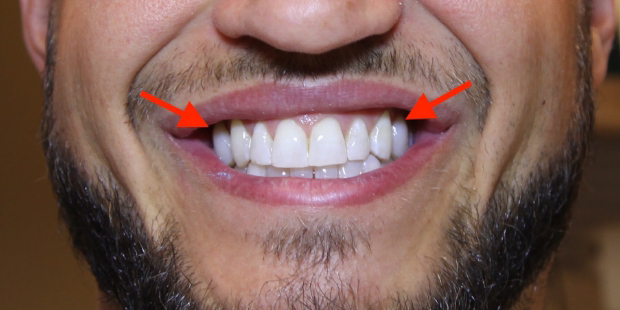 Close up of a man smiling after cosmetic dental treatment