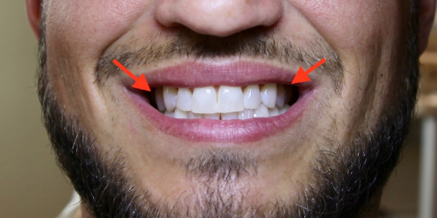 Close up of a man smiling with dark spots on a couple of teeth