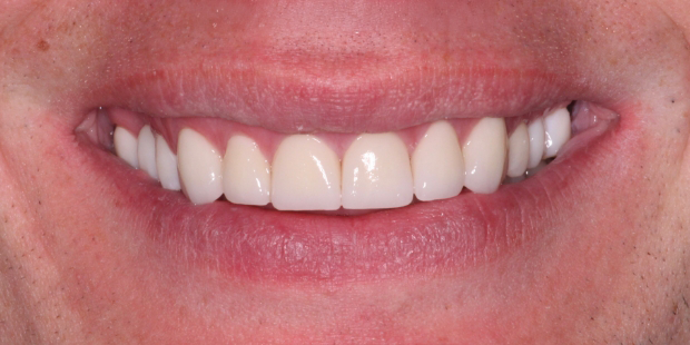 Close up of a smile with evenly sized and spaced and whiter teeth