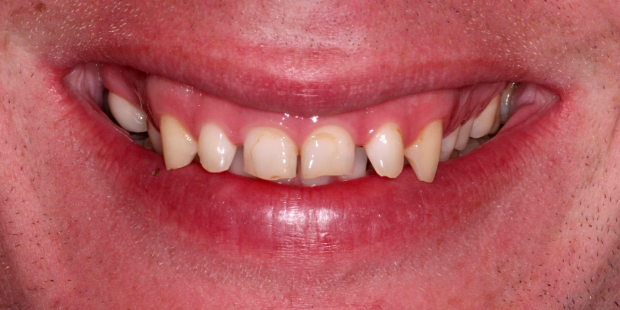 Close up of a smile with short gapped and discolored teeth