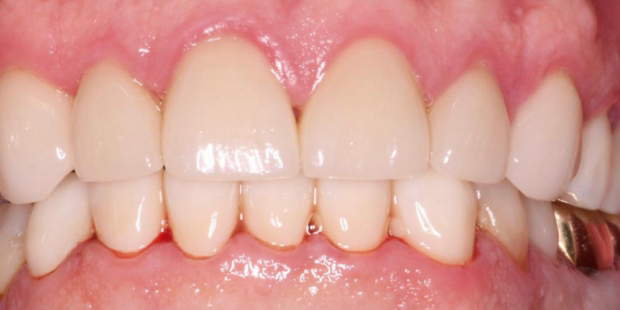 Mouth after treating damaged and stained teeth