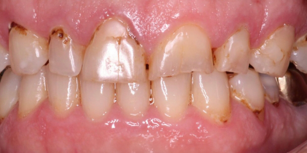 Mouth with several damaged and stained teeth