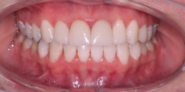 Mouth after correcting white stains on multiple teeth