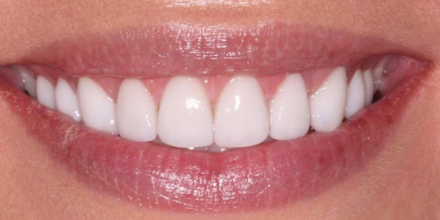 Smile with straight teeth and no Invisalign attachments