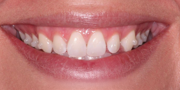 Smile with Invisalign attachments on several teeth