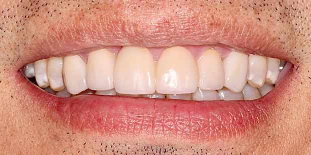 Smile after removing dark stains on multiple upper teeth