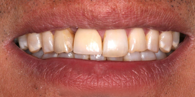 Smile with dark stains on multiple upper teeth